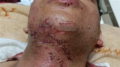 أطباء مستشفى الطوارئ بجامعة سوهاج ينقذون حياة شاب تعرض لإصابات بالغة