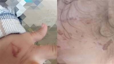 أب يتهم طليقته بتسببها فى إصابات وجروح لصغيره قائلة: 