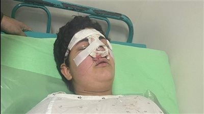 خاص .. إصابة طالب بكسر في الأنف بعد واقعة تنمر داخل مدرسة خاصة ببني سويف