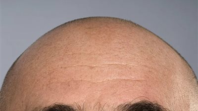 وداعا لعمليات زرع الشعر.. طريقتين فعالتين لمكافحة الصلع