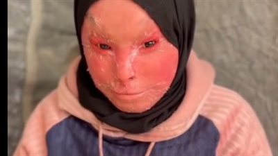 الطفلة شهد تُصارع مرض السماك وتستغيث من أجل العلاج خارج غزة: «نفسي أعيش طفولتي» 