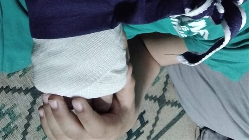 كسر ذراع الطفل
