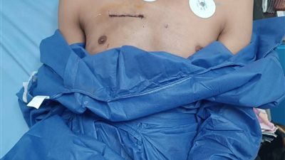 بنى سويف الجامعى| إنجاز طبي بإجراء جراحة قلب مفتوح بتقنية التدخل المحدود