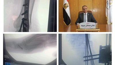 نجاح 5 عمليات جراحية بقسم العظام بمستشفى الفشن المركزي في بني سويف 