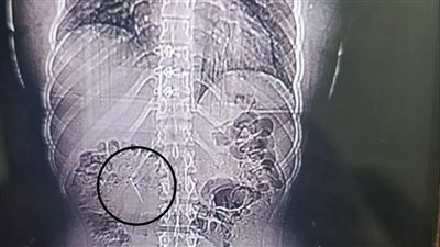 إنقاذ فتاة بعد ابتلاعها دبوسا معدنيا بطول 4 سم ببورسعيد