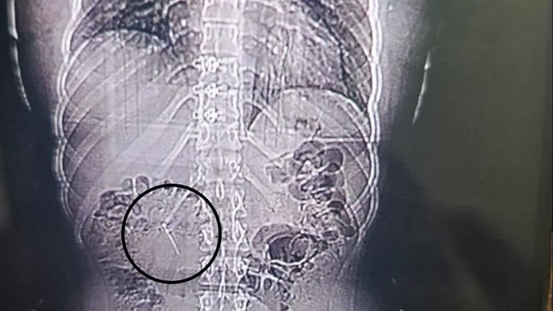 الدبوس داخل أمعاء