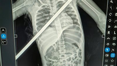   إنقاذ طفلة اخترق صدرها سيخ حديدي في جراحة نادرة بجامعة بنها