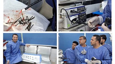 استخراج 100 مسمار وصامولة من معدة مريض بدون تدخل جراحي ببني سويف الجامعي