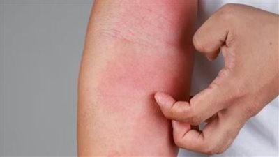 حرارة الصيف تهدد البشرة.. خطوات بسيطة تحميك من الالتهابات الجلدية