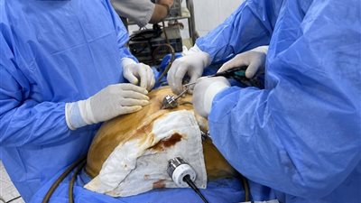 بأوزان تصل إلى ١٩٠ كجم.. نجاح ٣ عمليات تكميم معدة بمستشفى ههيا بالشرقية