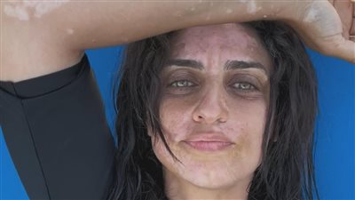 شقيقة أمير كرارة بعد تصدرها التريند لإصابتها بالبهاق : بقالي 3 سنين