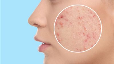 ليس بسبب قلة النظافة.. ما الذي يسبب حب الشباب وكيف يمكن علاجه؟