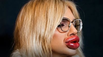 بسبب كمية الفيلر.. مؤثرة بلغارية تفقد القدرة على إغلاق فمهما