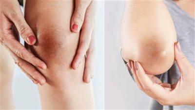 لماذا يزداد اسمرار الركبتين والكوعين في الصيف؟.. 4 أسباب وحلول بسيطة
