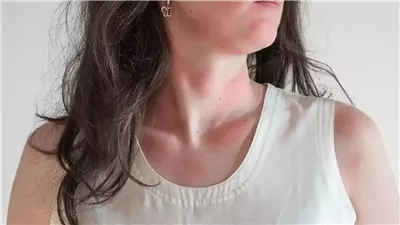  طفح الرقبة في الصيف.. متى يكون مجرد تهيج أو يستدعي الانتباه؟ 