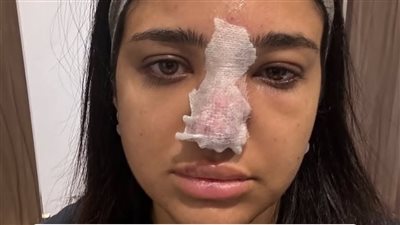 تآكل أجزاء من أنف كنزي مدبولي بعد حقن الفيلر.. طبيب يكشف مخاطر الإجراء |خاص