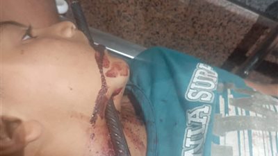 5 ساعات بغرفة العمليات.. مستشفى سوهاج تنقذ حياة طفل بعد اختراق سيخ رقبته